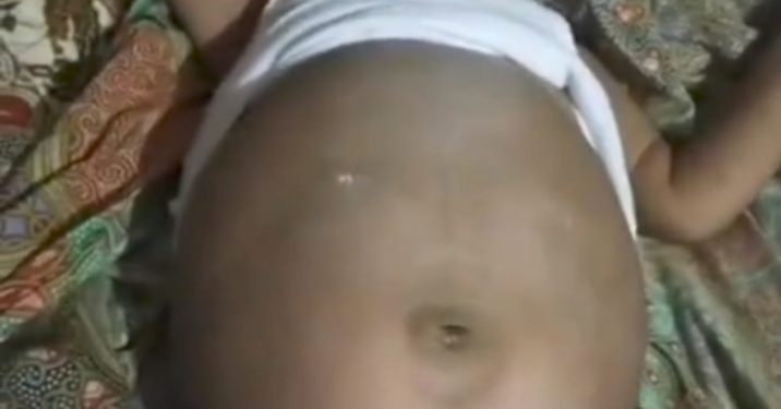 Viral Dan Kejadian Langka! Bayi 5 Bulan di Pesisir Selatan Diduga Hamil, Perut Membesar dan Butuh Operasi