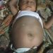Viral Dan Kejadian Langka! Bayi 5 Bulan di Pesisir Selatan Diduga Hamil, Perut Membesar dan Butuh Operasi